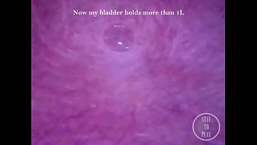 Can I fit the minicam AND a catheter inside my pee hole at the same time?